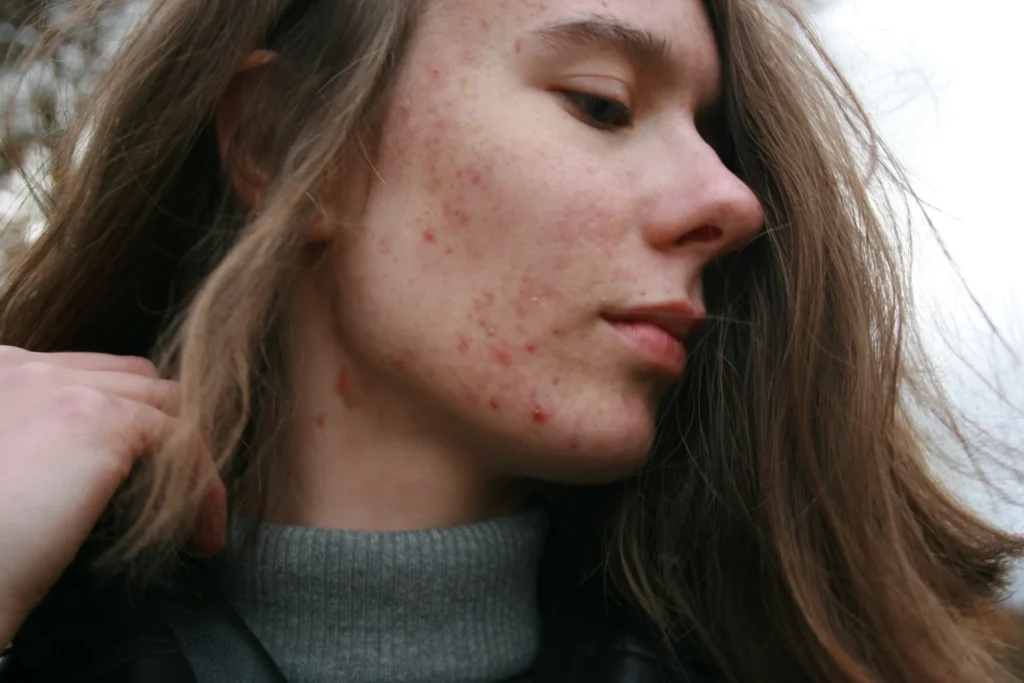 visage adolescent avec des l'acnée